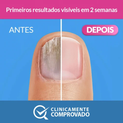 Excilor Solução Tratamento Antifúngico Unhas 3,3ml | Farmácia d'Arrábida