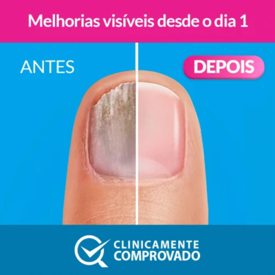 Excilor Forte Verniz 30ml Fungos Unhas | Farmácia d'Arrábida