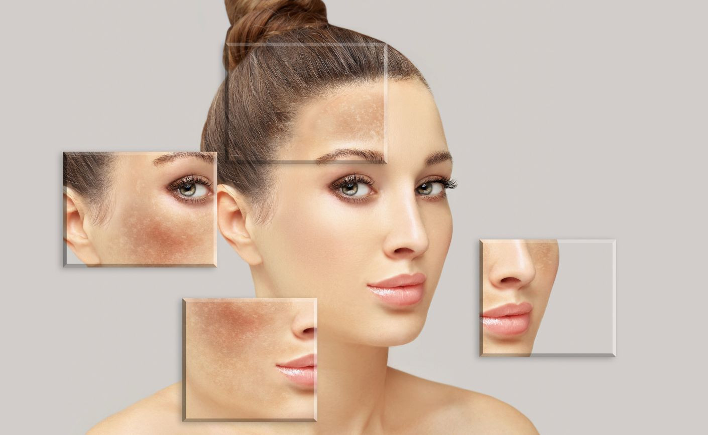 Melasma e cuidados com a pele: Como uma rotina de skincare pode ajudar